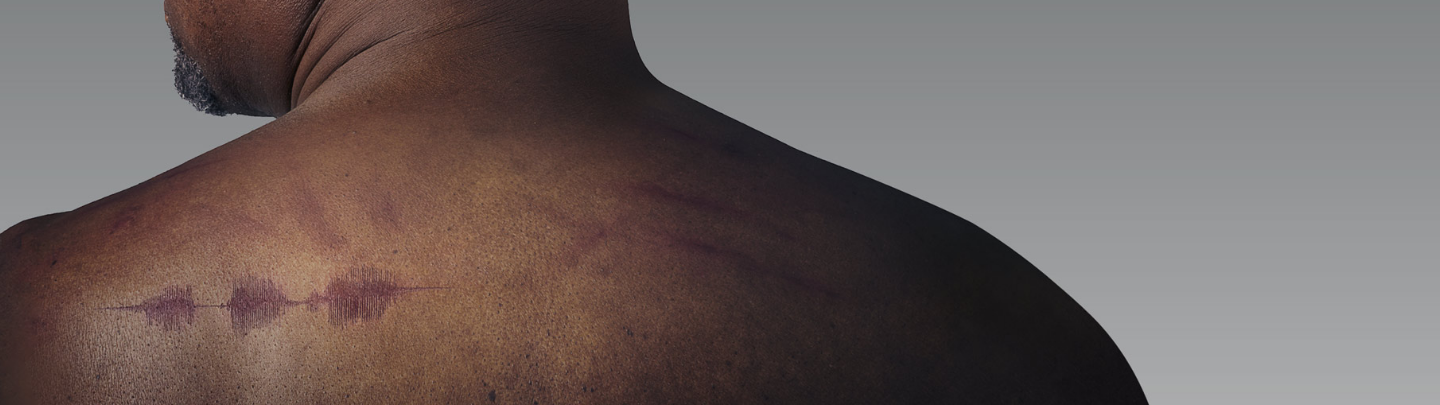 A close up of a man's neck and shoulders with a visible graphical representation of uncomfortable, itchy skin.