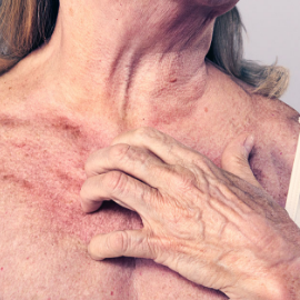 A close up Image of woman scratching her upper chest, it looks visibly uncomfortable.